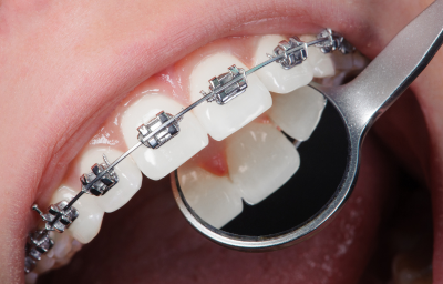 Dental Braces
